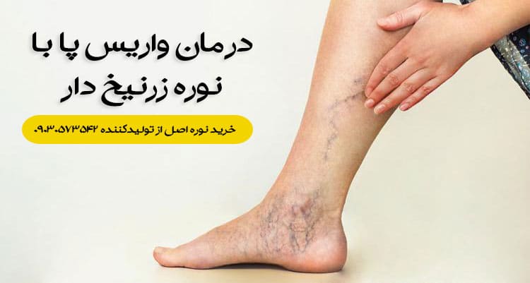 نوره برای درمان واریس پا