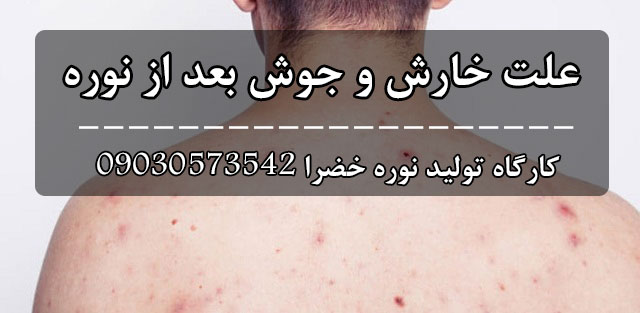 علت خارش بعد از نوره
