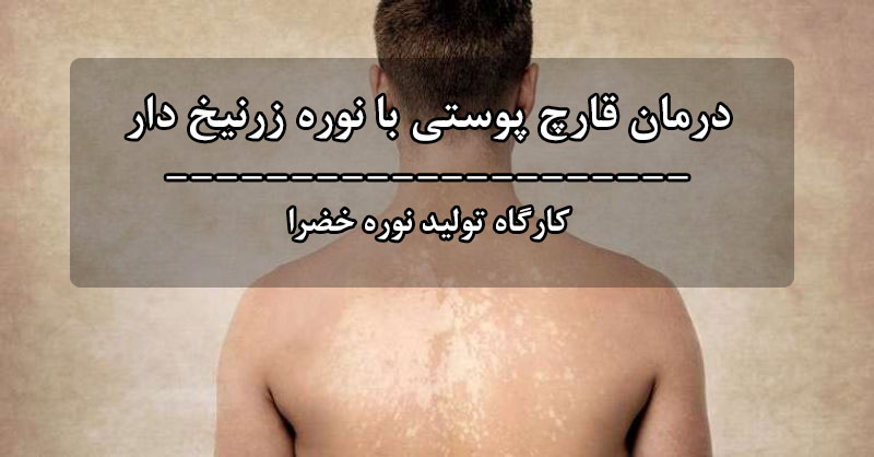 درمان قارچ پوستی با نوره